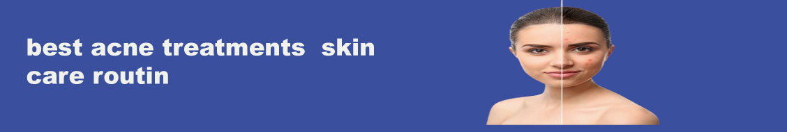 best acne treatments  